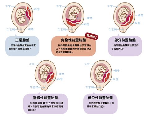 前置胎盤原因